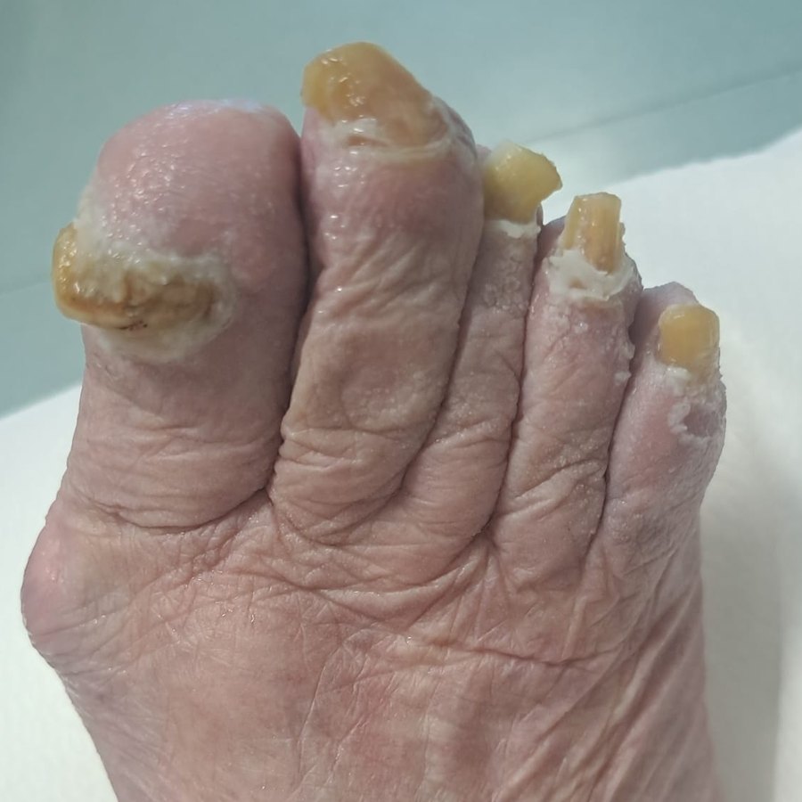 Antes: unhas grossas e em grifo