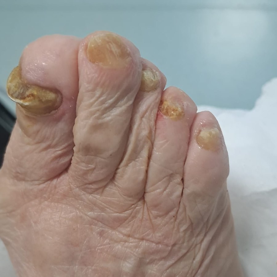 Depois: unhas desbastadas e cortadas numa visita